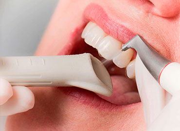 professional_tooth_clining